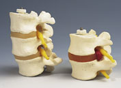 Tres discos vertebrales, montados flexibles  A76/8