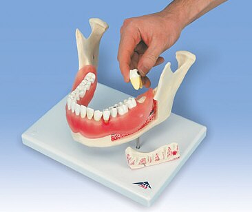 Afección dental, a 2 aumentos, de 21 piezas D26