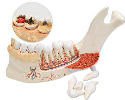 Mitad de la mandíbula inferior con 8 dientes cariados, 19 piezas, escala 3:1 VE290
