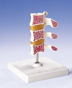 Modelo de osteoporosis - Versión de Lujo (3 Vertebrales)  A78