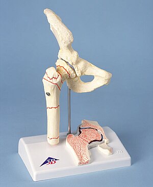 Fractura de fémur y desgaste de la articulación de la cadera  A88