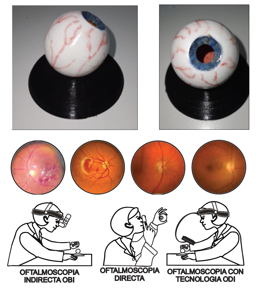 Conjunto de 4 modelos de ojo humano adulto para practicar exploración de fondo de ojos (1 normal, 3 con patologías) O-SIM 2 A