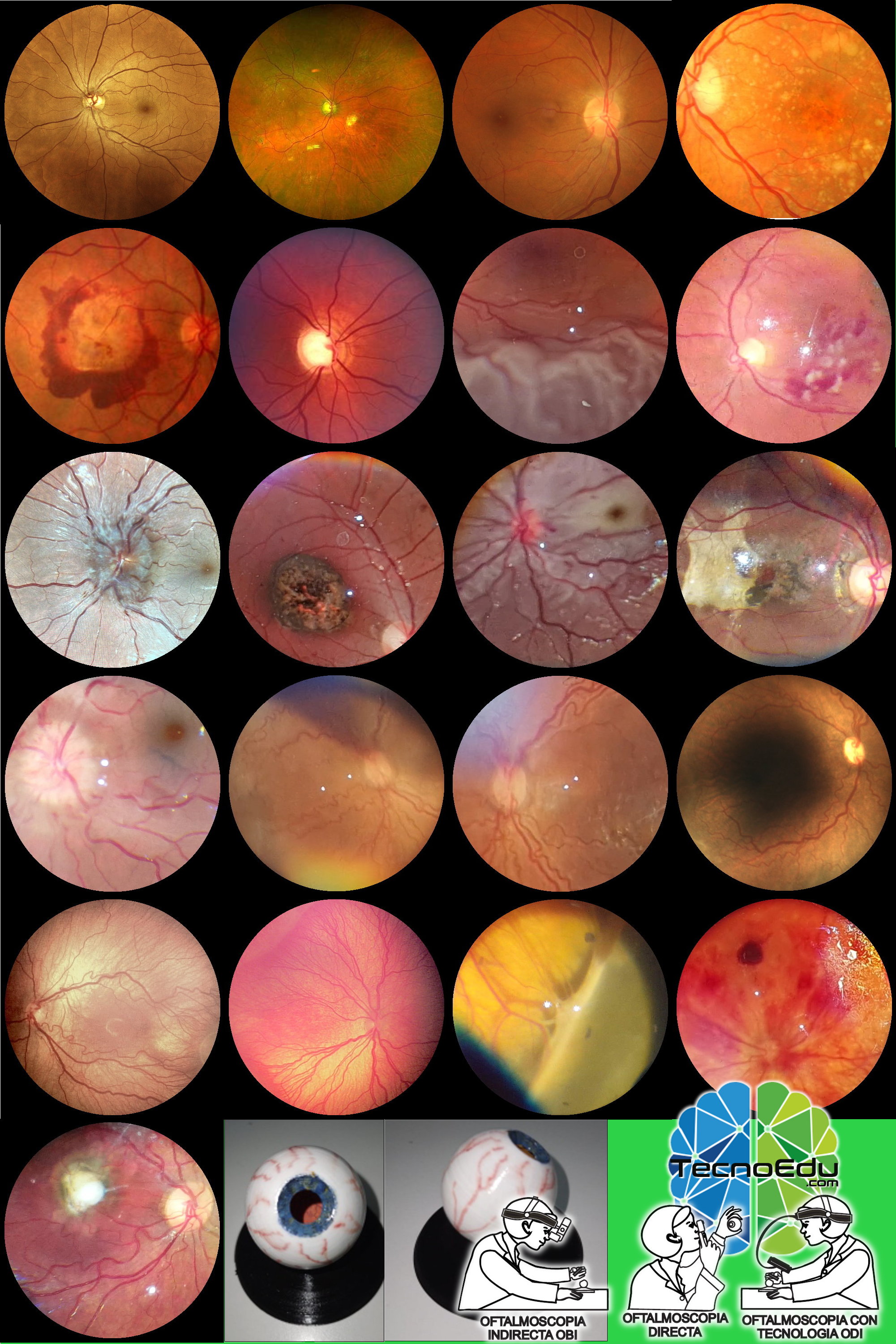 Colección de 21 maquetas para practicar exámenes oftalmológicos de fondo de ojo (FO) Oftalmo kit FO